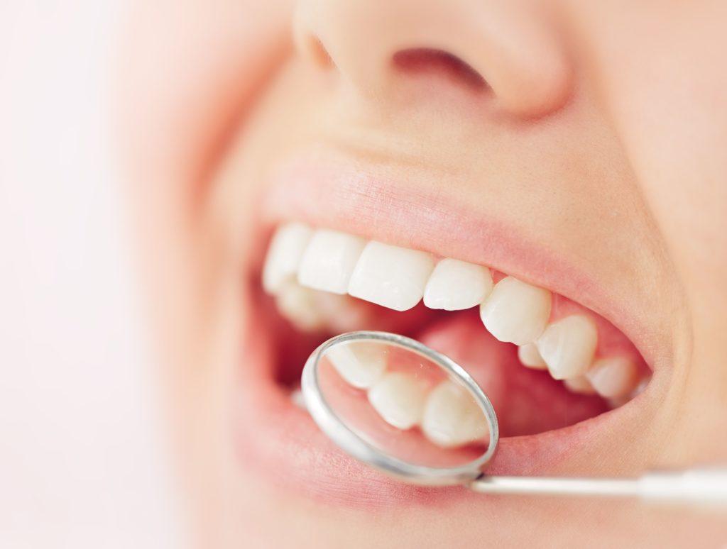 All-on-4 Dental Implants 27 filling2